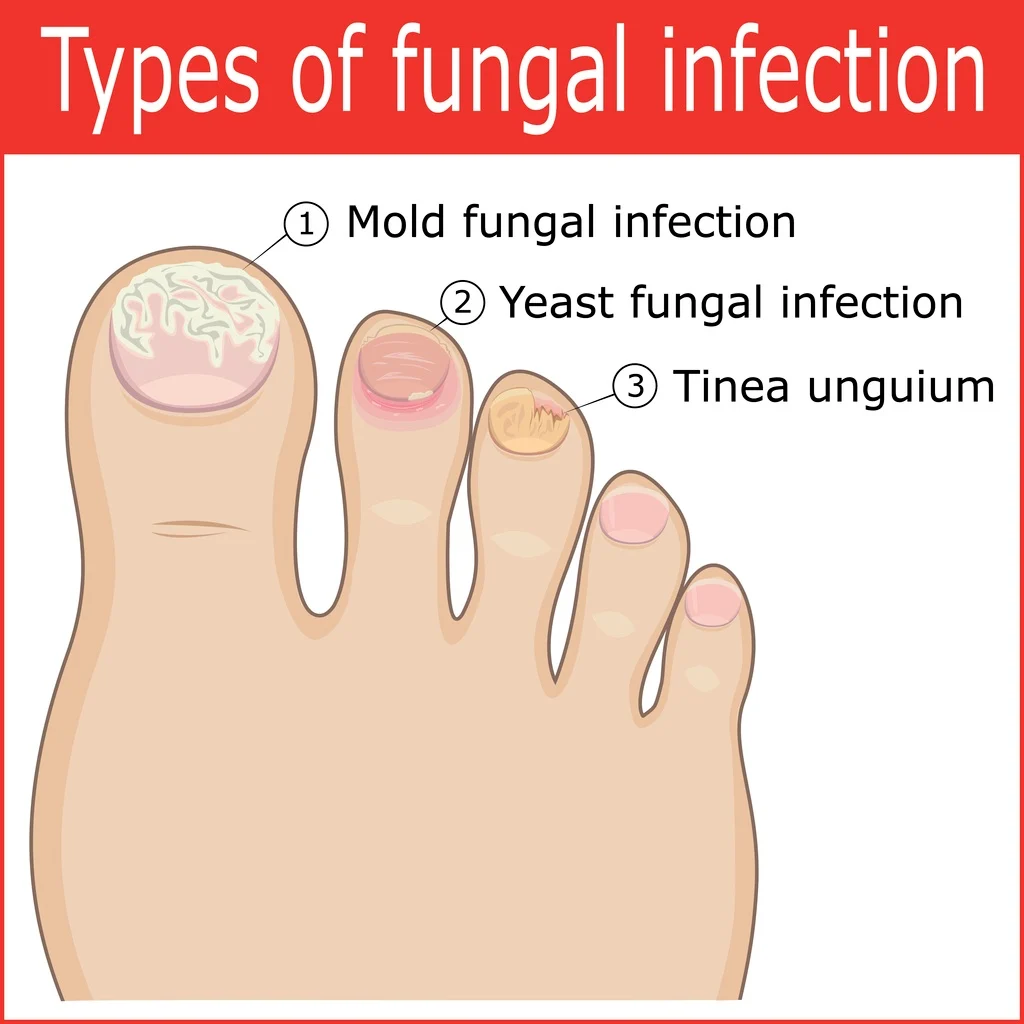 Understanding and Treating Toenail Fungus: A Comprehensive Guide
